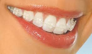 Pin Di Clear Braces Chennai