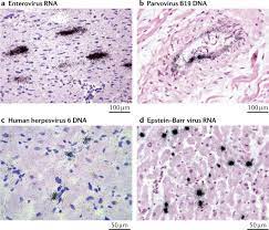 Myocarditis is an inflammatory disease of the myocardium with a wide range of clinical presentations, from subtle to devastating. Myocarditis And Inflammatory Cardiomyopathy Current Evidence And Future Directions Nature Reviews Cardiology