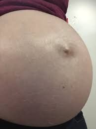 Outie Belly Button Or Umbilical Hernia Babycenter
