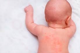 Yo Me Cuido Bebes Y Ninos Como Saber Si Mi Hijo Es Alergico A Un Alimento