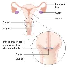 Even if you are at risk, at least you have plenty of time to prevent is which is actually effective. Cervical Intraepithelial Neoplasia Wikipedia