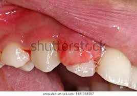Image result for granuloma gum disease