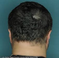 Having lost hair due to stress over the pandemic, both erica (left) and aggie added hair extensions and color to revive. Pill That Can Cure Baldness In Five Months For Alopecia Sufferers Daily Mail Online