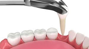 Pull Your Tooth or Save It? Which is Best? - Caputo Dental