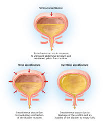 Image result for Functional Incontinence