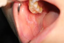 Oral Diseases And Cancer Medical Orofacial Surgery