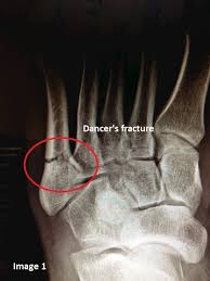 The most common fracture of the fifth metatarsal base is an avulsion of the tuberosity. Treatment Options For 5th Metatarsal Fractures Myfootshop Com