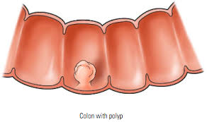 Bowel cancer is a cancer that starts in the large bowel and the back passage. Colorectal Cancer Crc American Gastroenterological Association