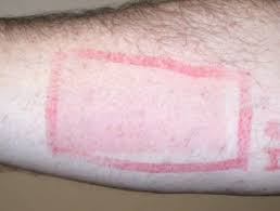If that doesn't work, sunlight may be the problem. Sunscreen Allergy Dermnet Nz