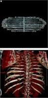 Image result for Chest Trauma