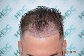 Others will take longer for the hairs to emerge and increase their density and thickness. Hair Transplant Market Expected To Grow At Approx 24 Cagr Up To 2023 By Bernstein Medical Bosley Cole Instruments Ethics Hair Instruments Etc Market Research Future Medgadget