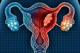 This involves the additional removal of the cervix and the top of your vagina, as well as the removal of the pelvic lymph nodes. Uterine Cancer Warning Signs To Watch For