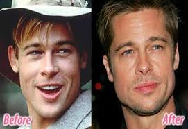 Celebrity Brad Pitt Ear Plastic Surgery Before After Plasticsurger Com Cosmetic Surgery Prominente Plastische Chirurgie Brad Pitt Plastische Chirurgie