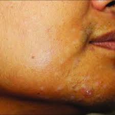 1 doctor answer • 2 doctors weighed in. Pdf Complications Of Laser And Light Based Devices Therapy In Patients With Skin Of Color