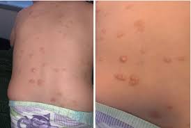 Image result for Urticaria pigmentosa children