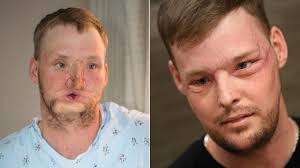 Dimeo went onto the transplant waiting list in late 2019, just a few months before the start of the coronavirus pandemic in. You Got A New Chance At Life Recipient Of Extremely Rare Face And Hands Transplant Doing Well Cbs News