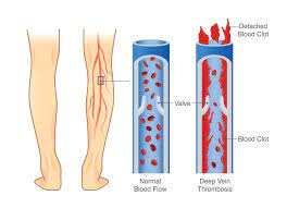 Deep Vein Thrombosis