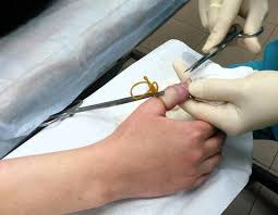 нарывает палец на ноге что делать в домашних условиях Chto Delat Esli Narval Palec Na Ruke Naryvaet Palcy Ruk I Nog Chto Delat Kak Lechit Naryv U Rebenka Pochemu Naryvaet Palec Vozle Nogtya Na Rukah I Nogah