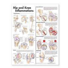 Pdf Download Hip And Knee Inflammations Anatomical Chart Pdf
