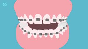 When you do not brush your teeth with braces properly, plaque builds up. How To Brush Your Teeth With Braces A Step By Step Guide Youtube