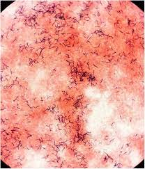 A Rare Case Of Brain Abscess Caused By Actinomyces Meyeri Bmc Infectious Diseases Full Text