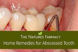 Pin On Abscess Tooth