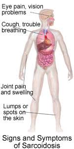 Despite careful preparation, it thus remains difficult to distinguish between these conditions even when lymph nodes are strictly evaluated. Pulmonary Sarcoidosis Mid State Pulmonary Pulmonary And Sleep Medicine Nashville Tn