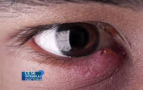 Netratata O Simpla Umflatura A Ochiului Poate Genera Probleme De Vedere Principalele Afectiuni Ale Pleoapelor Stirileprotv Ro