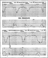 Image result for Variable Deceleration