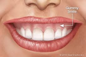 How to fix a gummy smile with braces. Fixing A Gummy Smile What Are My Options Philadelphia Dentistry