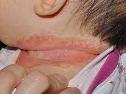 Tapi, benjolan yang menandakan perlunya pengobatan, seperti dalam kasus infeksi, tetapi jarang merupakan tanda dari masalah yang berbahaya atau mengancam nyawa. Tip Sembuhkan Ruam Dan Luka Di Pelipat Kulit Bayi May 2021 Kelabmama Malaysia