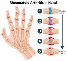 Researchers don't know what causes the immune system to attack the synovium, the lining of the joints. Rheumatoid Arthritis Ra Anova Irm Germany