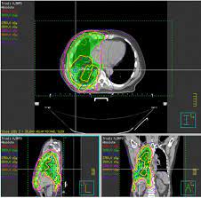 Trimodality treatment of malignant pleural mesothelioma. The Use Of Radiation Therapy For The Treatment Of Malignant Pleural Mesothelioma Expert Opinion From The National Cancer Institute Thoracic Malignancy Steering Committee International Association For The Study Of Lung Cancer And
