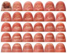 How long does it take for a nail to grow back? Lasertoenailcenter Com Long Island Ny