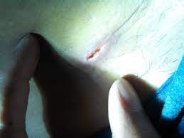 After the birth, the physician cleans the incision and closes it with several episiotomy stitches. Ripe The Stitches After 1 5 Month Of Cesarean Delivery Pregnancy Babycenter India