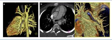 This page is about the various possible meanings of the acronym, abbreviation, shorthand or slang term: Role Of Msct And Mri In The Diagnosis Of Congenital Heart Disease Semantic Scholar