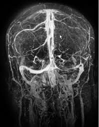 The venous circulation of the brain is done. How To Spot And Treat Cerebral Venous Sinus Thrombosis Acep Now