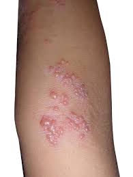 Image result for herpes zoster