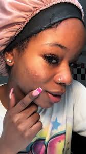 growth is me not popping this pimple rn 😂 #fyp #ourmedlife #pimplepatches  #acne #acnejourney