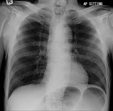 Image result for Sigmoid Volvulus