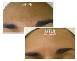Pin By 1 On 1 Spa On Hydrafacial Hydra Facial Oily Skin Treatment Hydrafacial Before And After