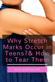 Pin On Stretch Marks