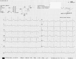 Krevní tlak se vyjadřuje ve dvou hodnotách. Ekg Z Praxe 20 Medicina Nemoci Studium Na 1 Lf Uk