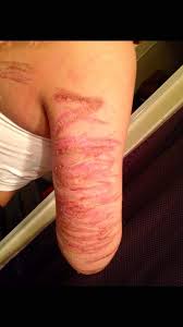 Explore more searches like epilepsy awareness tattoos. Girl Covers Scars From Seizure Accident With A Beautiful Tattoo Album On Imgur