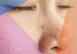 You can help speed up the process of healing by using warm compresses (press the eyelids with a clean washcloth soaked in lukewarm water.) clean the eyelids using baby shampoo or gentle soap. How To Get Rid Of And Prevent A Pimple Inside Your Nose