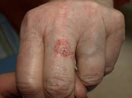 Red skin on your face can be embarrassing and hard to treat. Precancerous Skin Lesions Knowledge Amboss