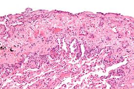 mesothelioma cancer causes www.mesothelioma.comchanges in these genes may cause cells to grow out of control, which can lead to cancer.asbestos exposure is the main cause of pleural mesothelioma. Latest Mesothelioma Life Expectancy Stats And Survival Rates On Health