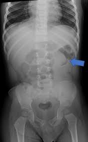 Image result for Intussusception