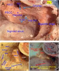 Trautmann triangle is demarcated by the bony labyrinth, the sigmoid sinus, and the superior petrosal sinus or dura. Temporal Bone Anatomy Cadaveric Dissection Iowa Head And Neck Protocols