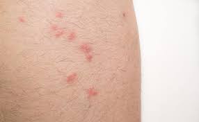 Image result for flea bites